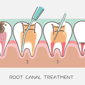 Root Canal