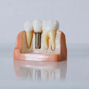 What Are Dental Implants? A Complete Guide for Patients